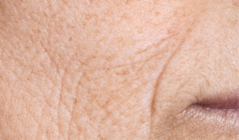 Profhilo supplier for aesthetic clinics